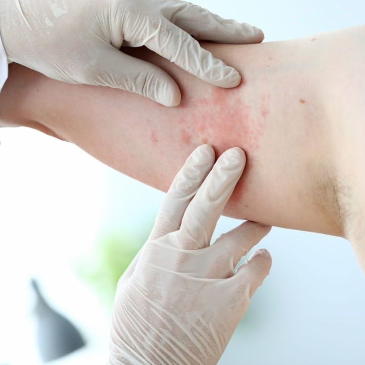 Alergia