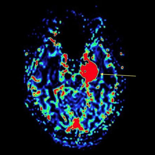 Cuarto curso práctico: Anatomía microquirúrgica de la disección de los surcos, circunvoluciones, ventrículos y fibras cerebrales aplicada al glioma, el aneurisma, la malformación arteriovenosa y la epilepsia