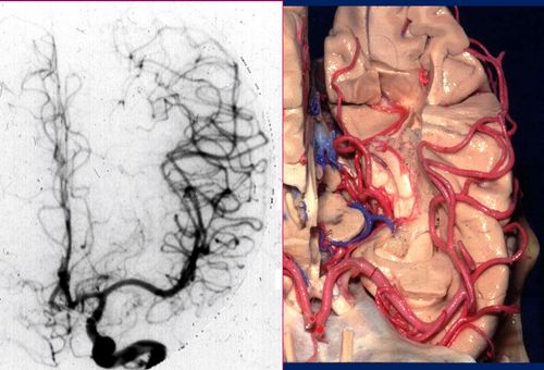 4th Hands-on Course: Microsurgical Anatomy of the Cerebral Sulci, Gyri, Ventricles, and Fiber Dissection Applied to Glioma, Aneurysm, AVM, and Epileps